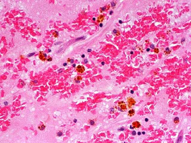 Figura 4. - Estroma tumoral laxo con presencia de macrfagos cargados con hemosiderina, hemorragia reciente y algunos linfocitos dispersos. Hematoxilina & eosina, 40x.